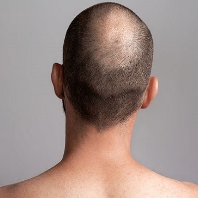 Can Crown Hair Transplant Boost Confidence