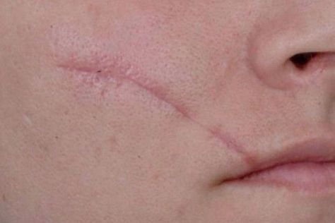Can Facial Scar Revision Smooth Raised Scars
