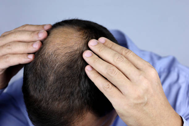 Can GFC Treatment for Hair Treat Bald Spots