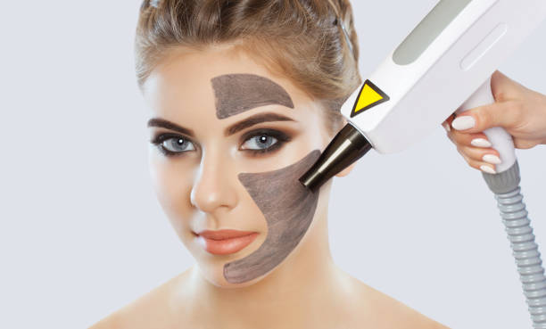 Can Laser Carbon Peel Brighten Skin