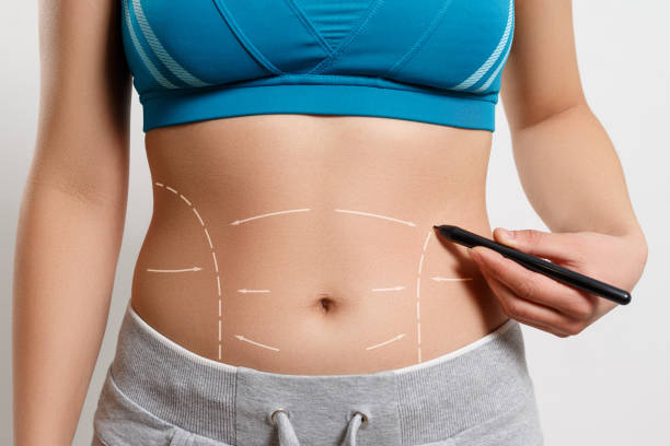 Can Lipo abdominoplasty Remove Stubborn Fat