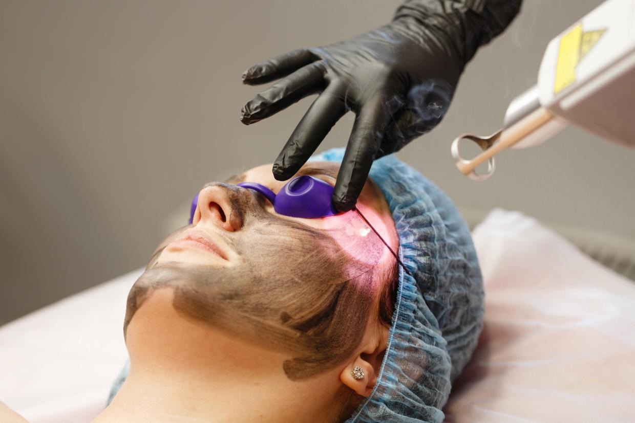 Carbon Facial Treatment in Dubai – Laser Hollywood Peel for Glowing Skin