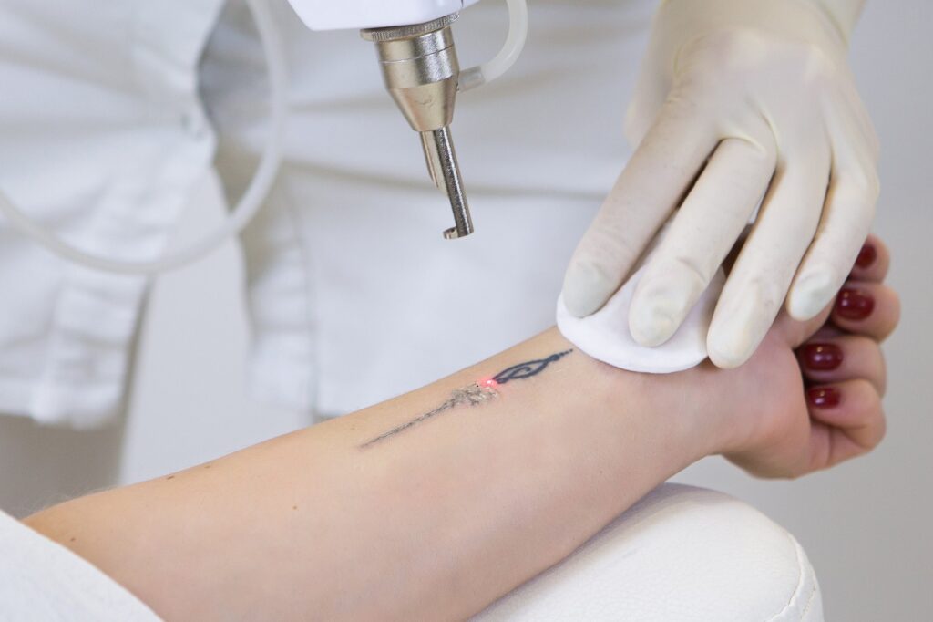 Customized Laser Tattoo Removal Plans