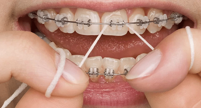 The Future of Invisible Dental Braces