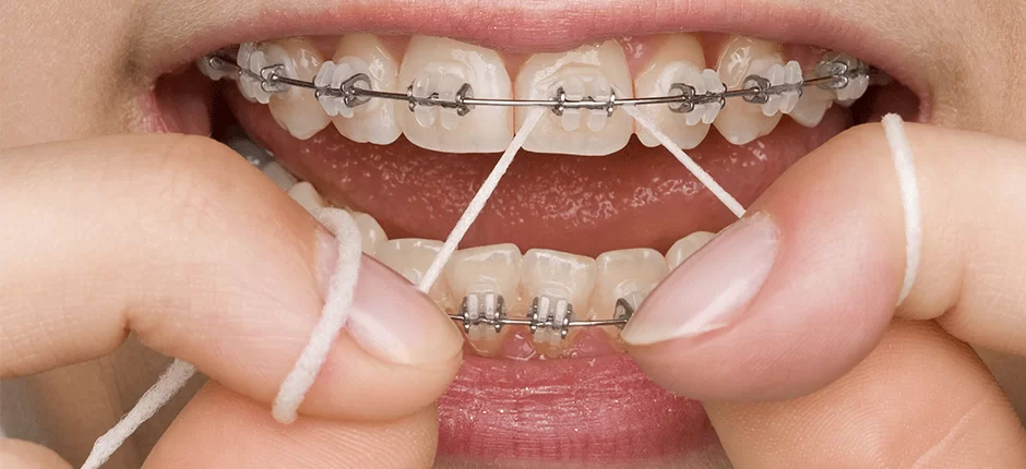 The Future of Invisible Dental Braces