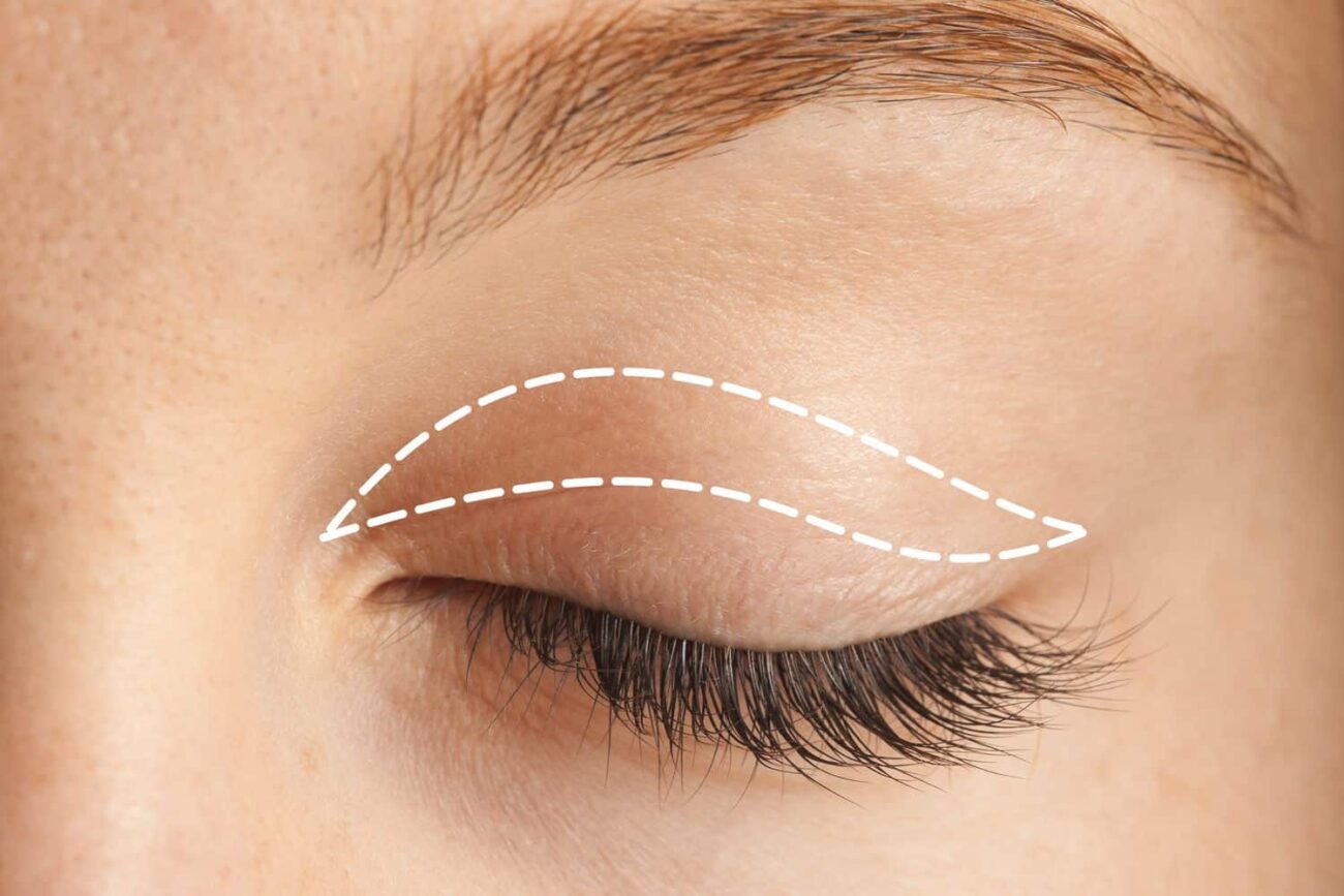Does Eyelid Surgery Improve Peripheral Vision
