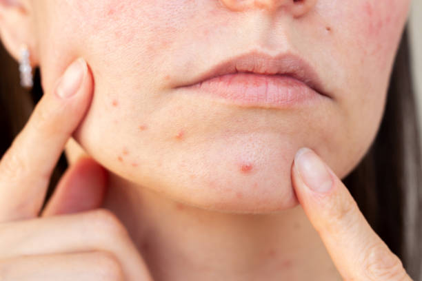 Does Laser Acne Scar treatment Suit All Skin