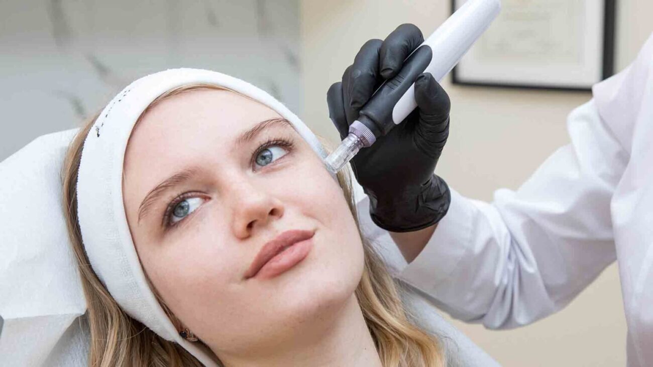 Does Microneedling Help With Acne Scars Quickly