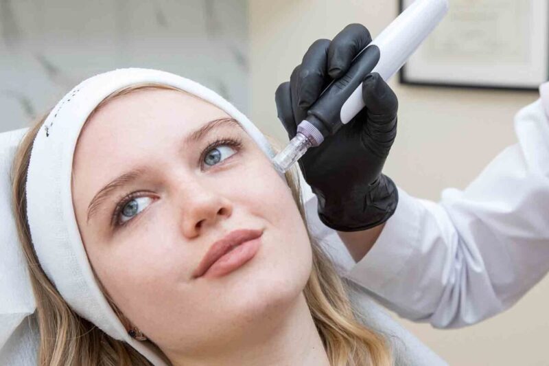 Does Microneedling Help With Acne Scars Quickly