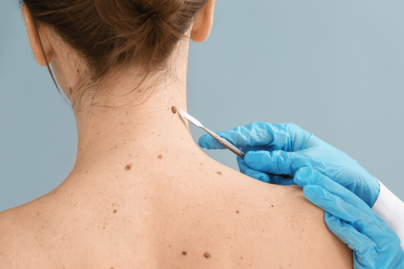 Does Mole Removal Prevent Future Growth