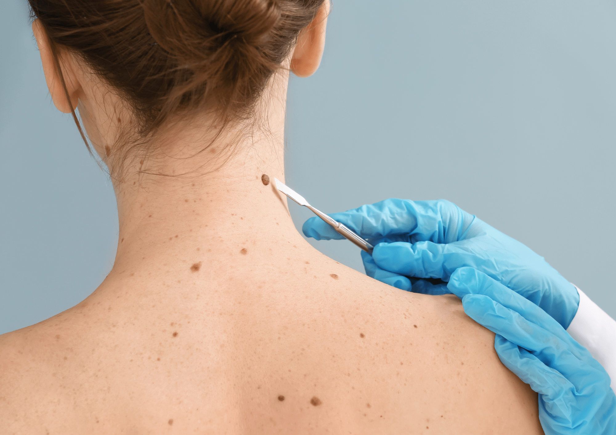 Does Mole Removal Prevent Future Growth