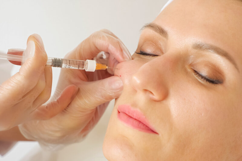 Elevate Facial Harmony with Cheek Fillers Injections