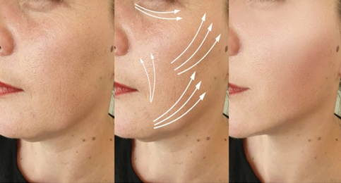 Non-Surgical Face Lift Options: Why Endolift Stands Out