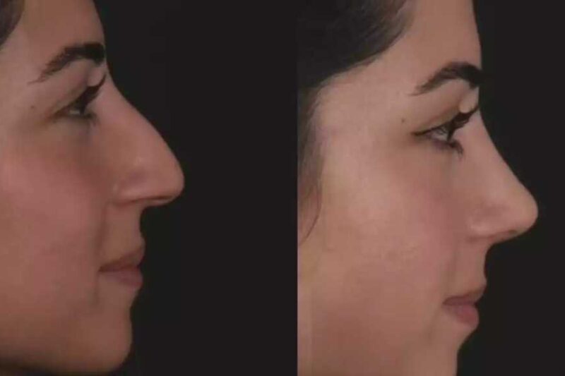 Best Septoplasty Surgeons in Dubai and Surgical Risk Reduction