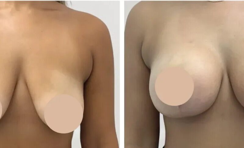 Breast Reduction in Dubai for Women Seeking Life-Changing Results