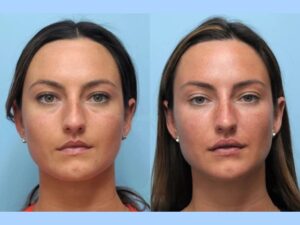 Best Plastic Surgeons in Dubai: Thread Lift Professional Facial Enhancement