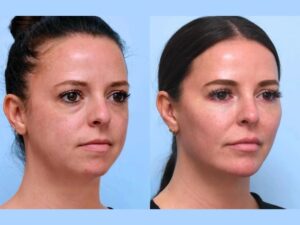 Best Doctors in Dubai for Premium Non Surgical Thread Lift