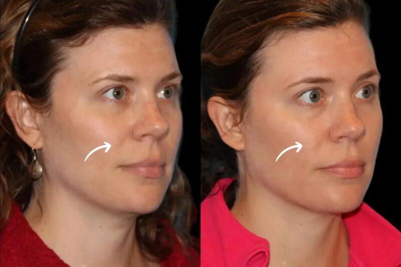 How Sculptra Enhances Cheek Volume at Best Aesthetic Clinic in Dubai