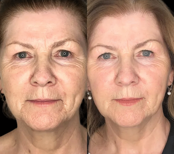 Why Are Profhilo Treatments in Dubai So Popular Today?