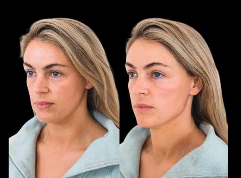 H7-Cheek-Fillers images