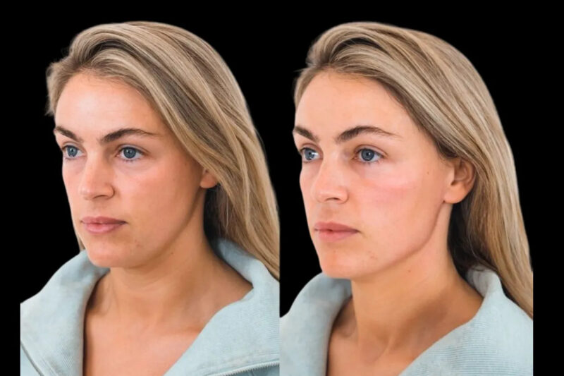 Achieving Natural-Looking Cheek Fillers Treatment in Dubai