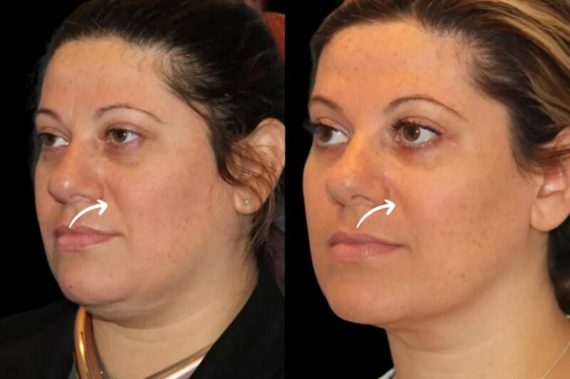 Achieve a Sculpted Jawline with Sculptra in Dubai