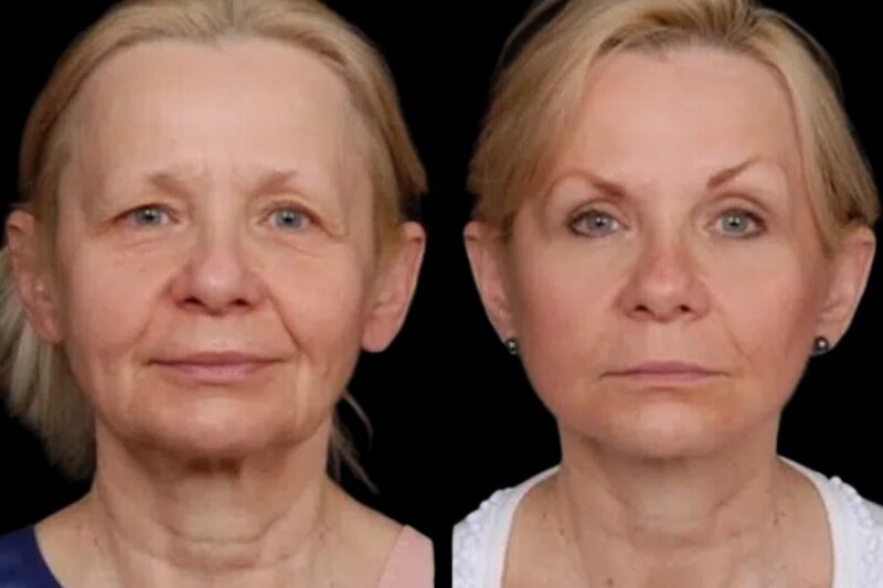 Under Eye Fillers Treatment in Dubai for a Youthful Look