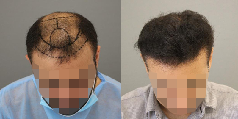 تكلفة زراعة الشعر في دبي