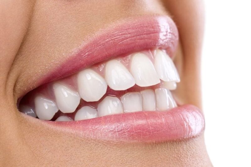 How E-Max Veneers Restore Chipped Teeth Perfectly