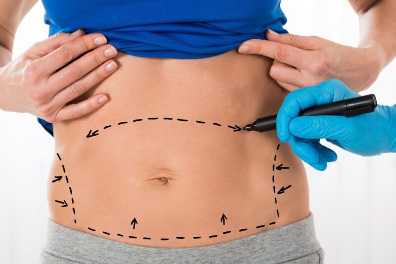 How Long Does Lipo Abdominoplasty Recovery Take