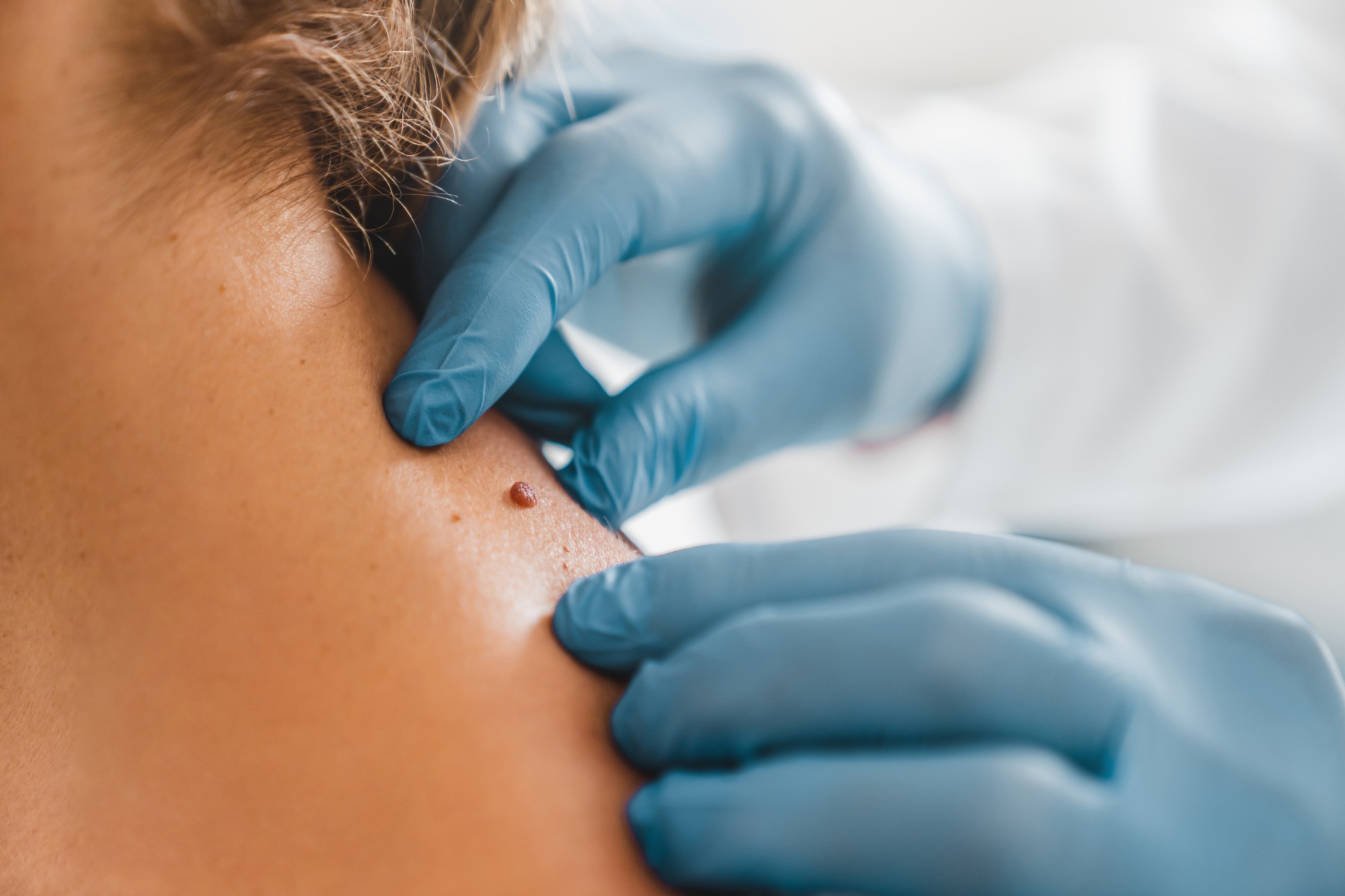 How Mole Removal Improves Skin Clarity