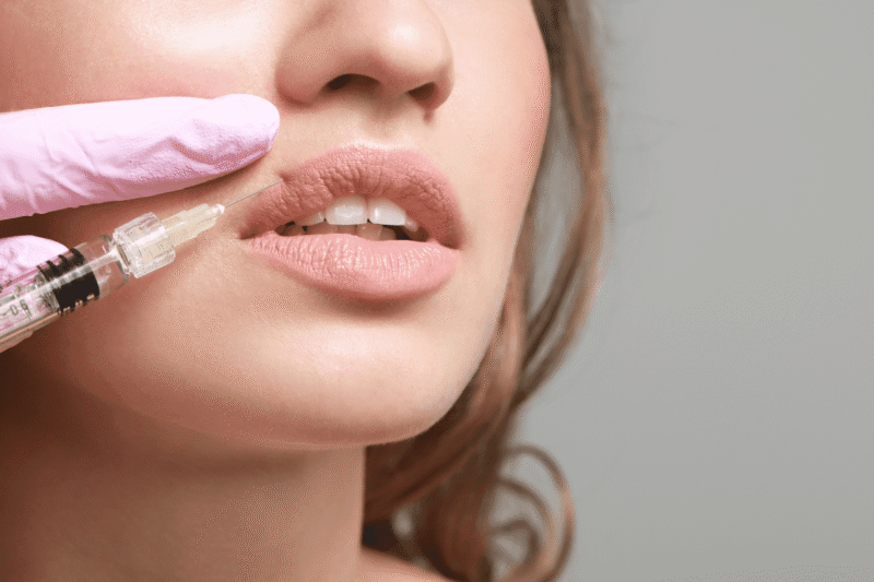 How Often Should You Refresh Lip Fillers