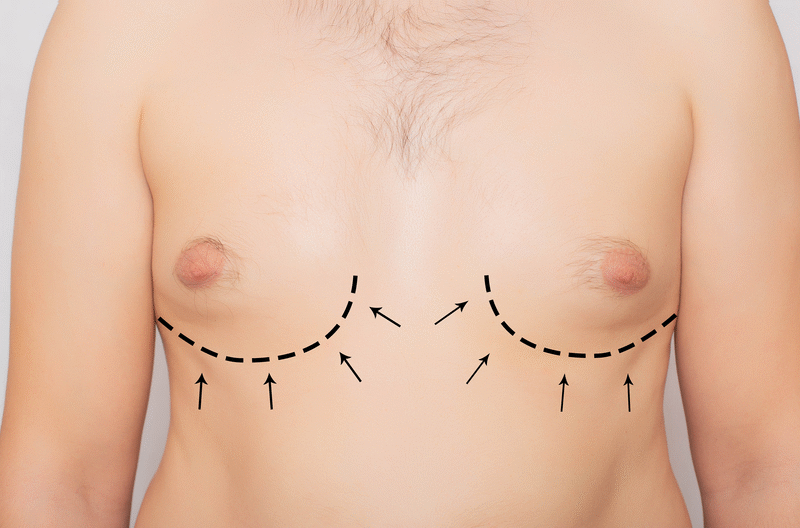 How Safe Is Gynecomastia Surgery for Men