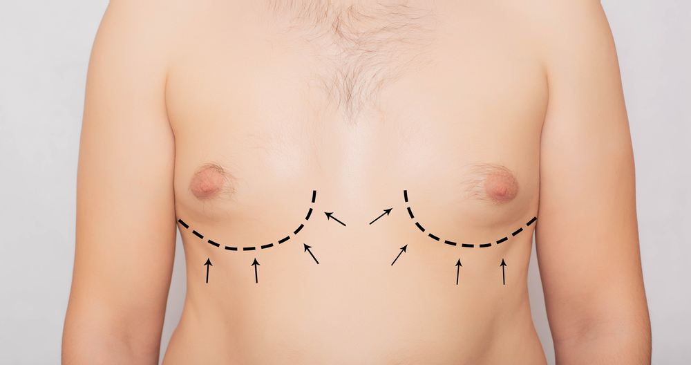 How Safe Is Gynecomastia Surgery for Men