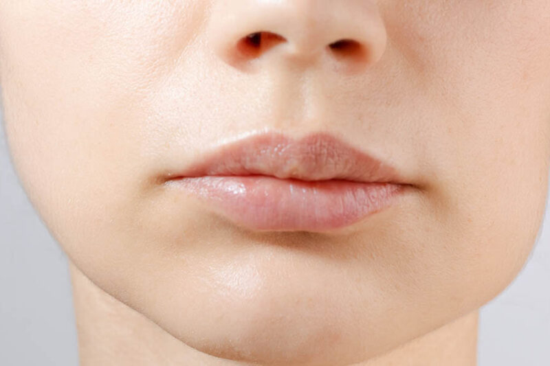 Is Buccal Fat Removal Permanent?