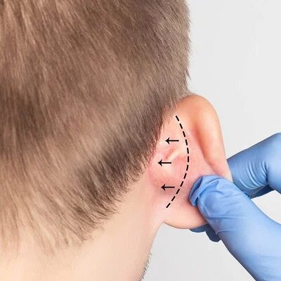 Is Ear Reshaping Safe for Adults and Teens