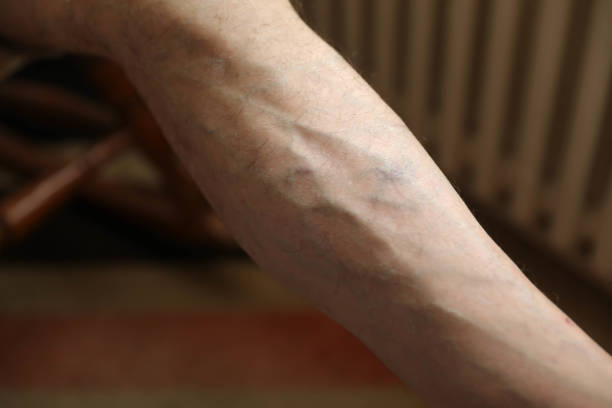 Is Sclerotherapy Suitable for Mild and Severe Veins?