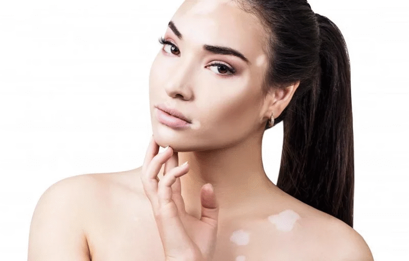 Is Vitiligo Treatment Safe for Children and Teens