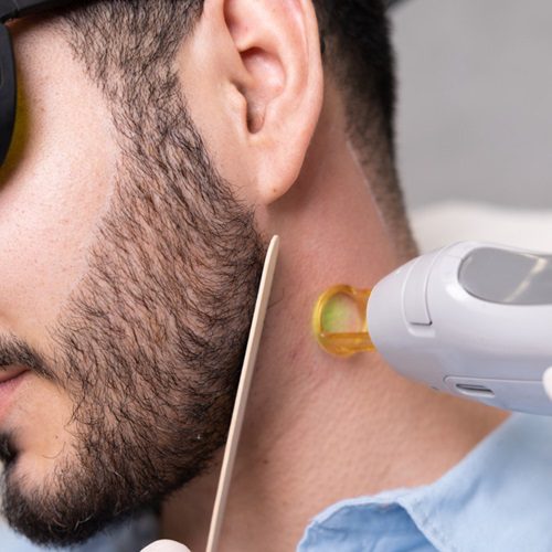 Is beard laser hair removal safe for skin