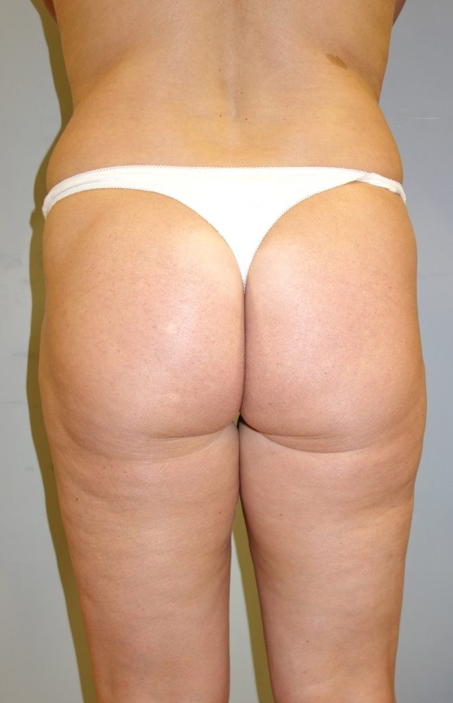 Lift and Contour Your Silhouette Without Surgery