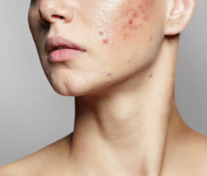 Professional Acne Treatment for Lasting Results