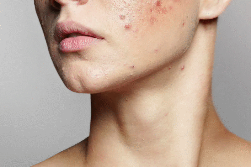 Professional Acne Treatment for Lasting Results