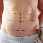 Redefine Your Shape through Tummy Tuck