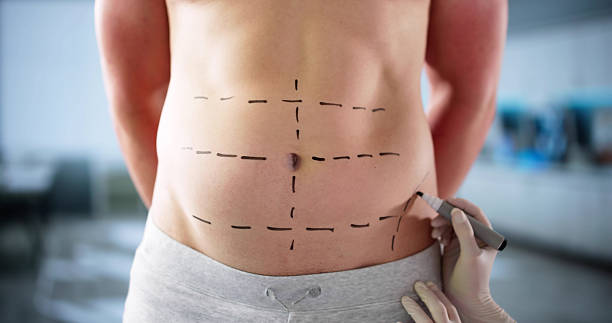 Redefine Your Shape through Tummy Tuck