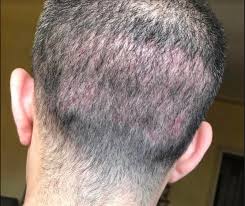 Regain Confidence with FUE Hair Transplant