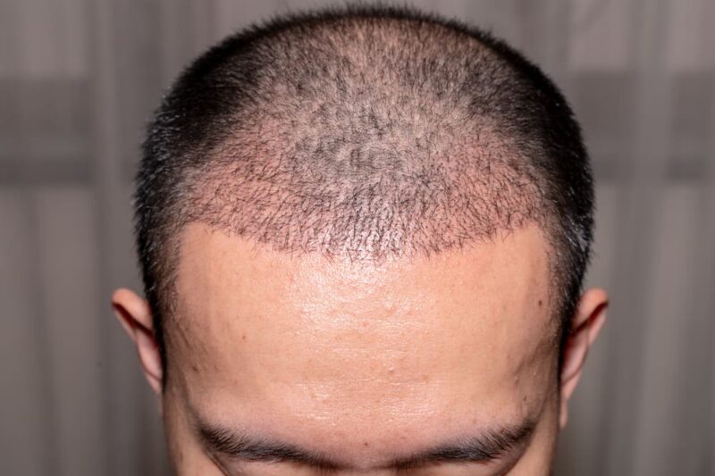 Regain Youthful Hair with Hair Transplant