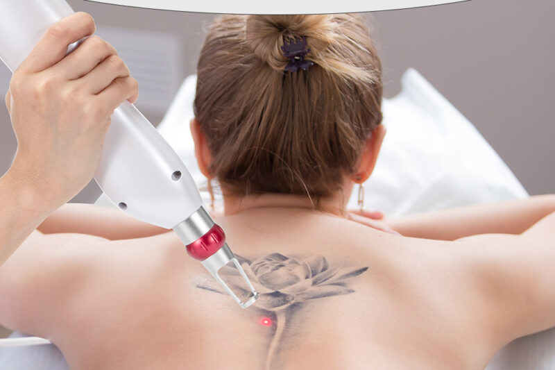Reveal Ink-Free Skin with Professional Laser Tattoo Removal