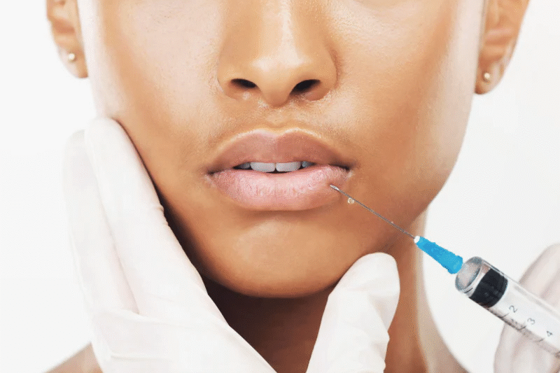 Lip Fillers at The Medispa: Enhance, Define, and Embrace Your Natural Smile