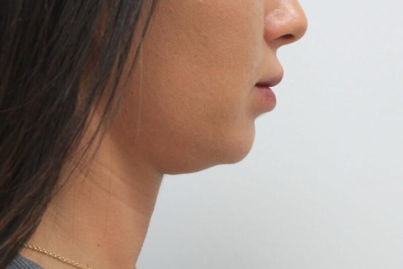 Target Stubborn Chin Fat with Kybella