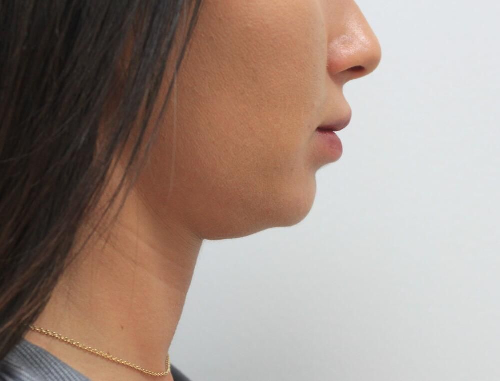 Target Stubborn Chin Fat with Kybella